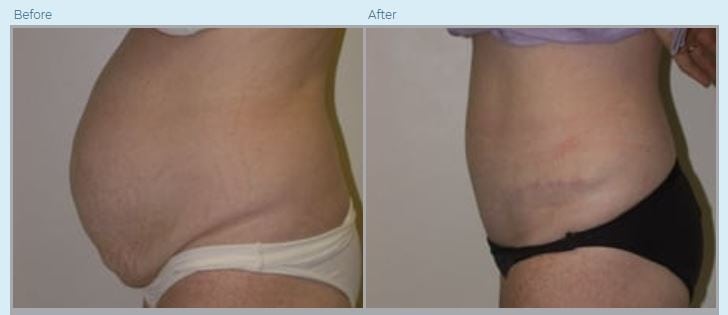 How Much Is a Tummy Tuck: Why the Cost Varies