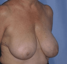 Breast Reduction Before and After Pictures in Middletown and Red Bank, NJ