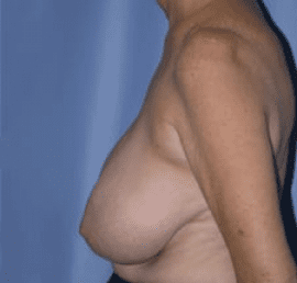 Breast Reduction Before and After Pictures in Middletown and Red Bank, NJ